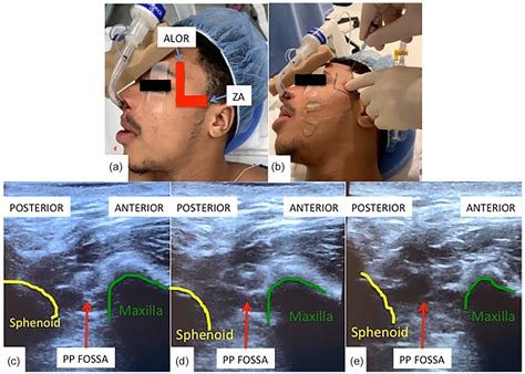 Maxillary Nerve Block Technique