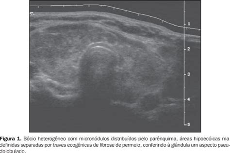 Radiologia Brasileira Achados ultra sonográficos na tireoidite