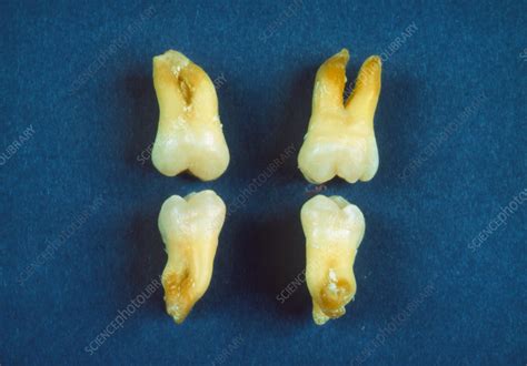 All Four Wisdom Teeth Removed Stock Image M7800024 Science Photo