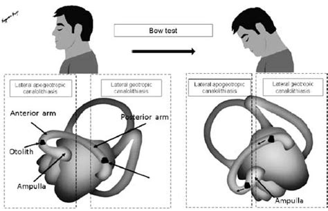 Mechanism Of Bowing Nystagmus In Apogeotropic And Geotropic