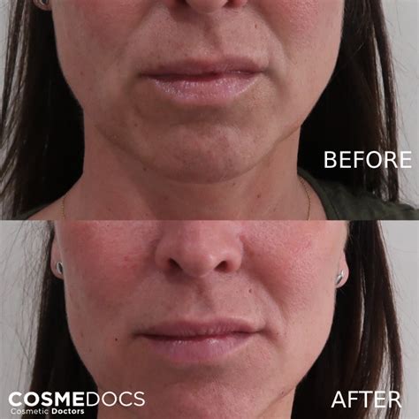 How To Get Rid Of Double Chin And Jowls With Injectables Safely
