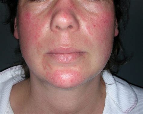 Skin Cancer Rash On Face