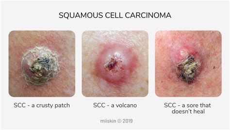 Early Squamous Cell Skin Cancer On Face