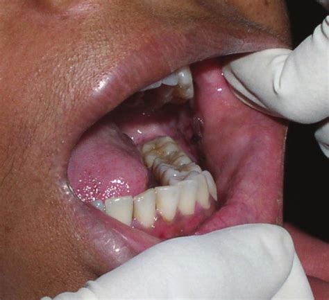 Postoperative Intraoral Picture Showing Well Healed Incisional Site
