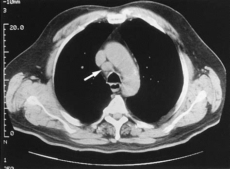 Mediastinal Lymph Node Staging Of Non Small Cell Lung Cancer A