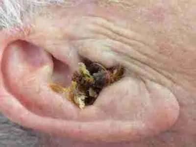 Microsuction Ear Wax Removal Lancing Sompting Ear Harmony