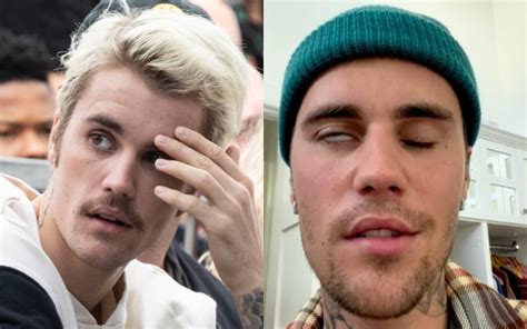 Justin Bieber Sufre El Síndrome De Ramsay Hunt ¿en Qué Consiste Y Cuáles Son Los Síntomas