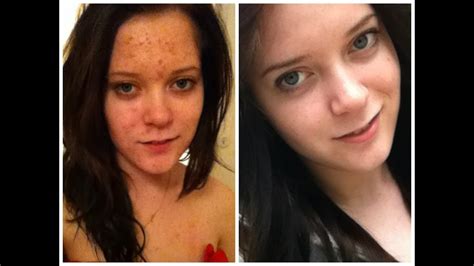 My Accutane Journey Beforeafter Pictures Youtube