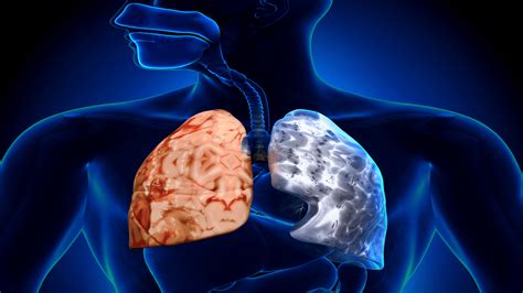 Chronic Obstructive Pulmonary Disease Copd Interactive Health