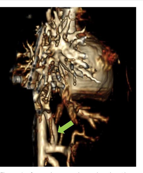 Figure 1 From Giant Major Aortopulmonary Collateral Artery A Rare