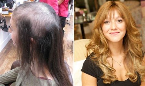 Teenager Left Almost Bald After She Pulled Her Own Hair Out Has