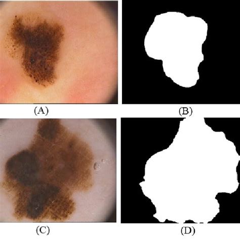 Different Types Of Dermoscopy Images For Both Type Benign And Melanoma