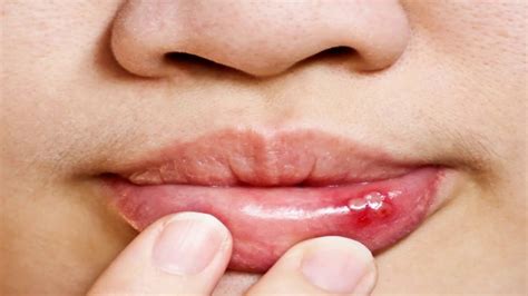 Difference Between Cold Sore And Herpes Youtube