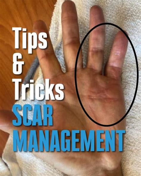 Scar Management Tips And Tricks