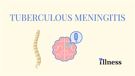 Tuberculous Meningitis Overview Causes Symptoms Treatment