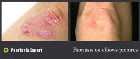 Psoriasis On The Elbows Psoriasis Expert