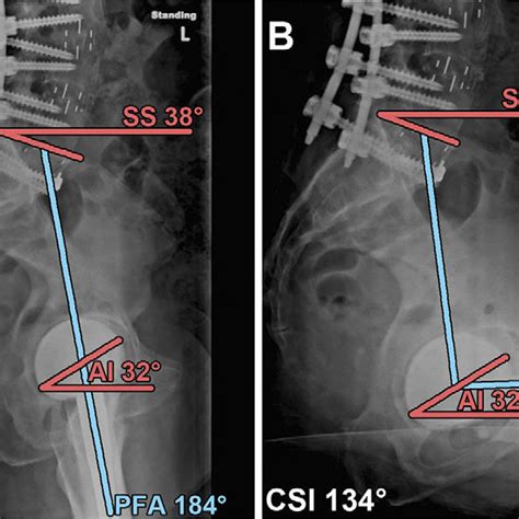 A Standing Lateral Radiograph Showing Loss Of Lumbar Lordosis And A