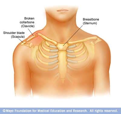 Image depicting multiple fractures of the left upper chest wall. Collarbone. Causes, symptoms, treatment Collarbone