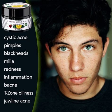 Cystic Acne And Scar Herbal Cream Lindpark Creations Naturals