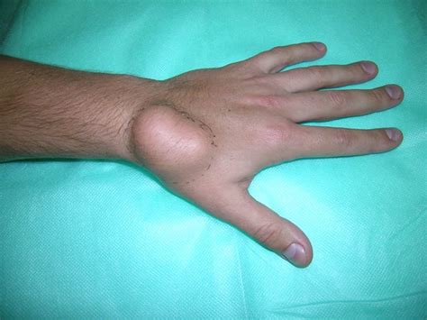 8 Lipoma On The Dorsum Of The Hand Download Scientific Diagram