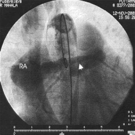 Aortogram Left Anterior Oblique Caudal View Showing The Fistulous