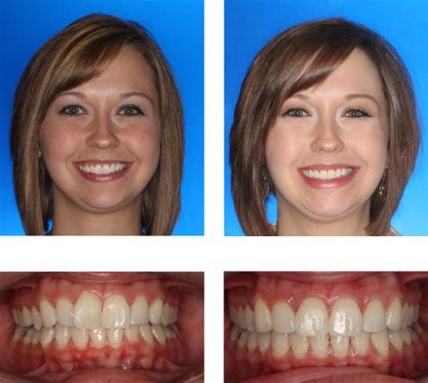 Invisalign Before And After Dr A B Hammond Orthodontics Pc