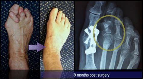 Minimally Invasive Lesser Toe Surgery David Redfern Surgery