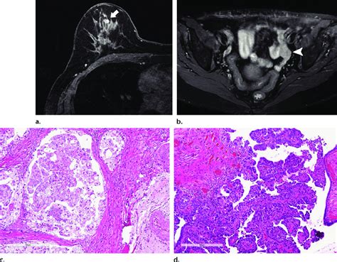 Triple Negative Invasive Ductal Carcinoma In A 61 Year Old Woman Who