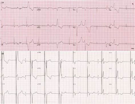 His Bundle Pacing In A Patient With Tricuspid And Mitral Prosthetic