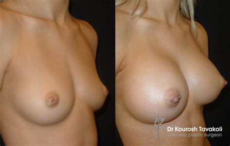 Nipple Areolar Correction Before And After Gallery Dr Tavakoli