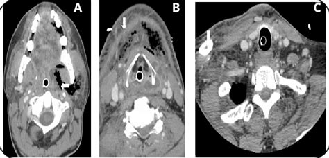Contrast Ct Of The Neck Demonstrating Extensive Fluid And Air