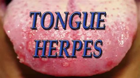 Brushing your teeth at least twice daily, and using mouthwash to rid the mouth of harmful bacteria. Tongue herpes - Herpes on Tongue, Tongue herpes cure - YouTube