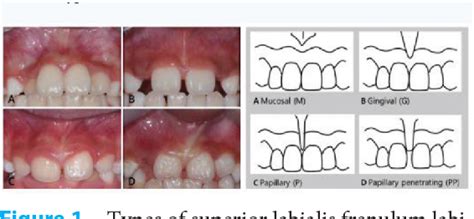 Management Of Maxillary Labial Frenum And Comparison Between Conventional Techniques And