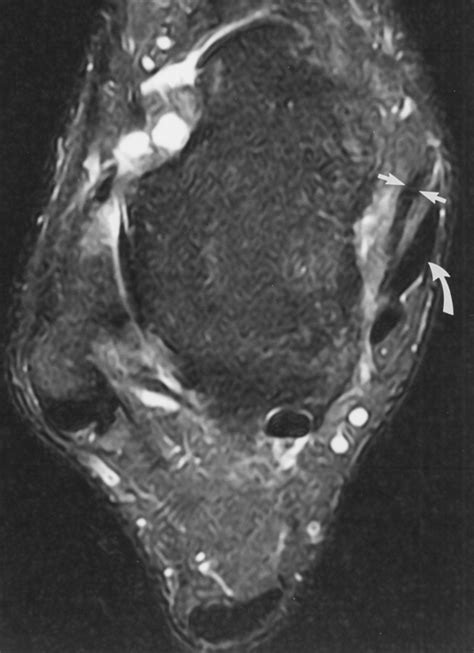 Association Of Posterior Tibial Tendon Injury With Spring Ligament