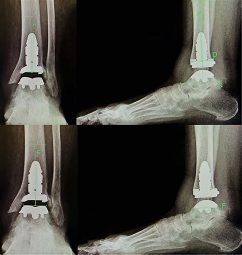 Total Ankle Arthroplasty With Anatomic Lateral Ankle Stabilization