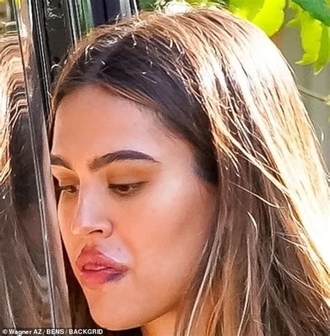 Amelia Hamlin Is Pictured With Bruising Around Her Puffed Up Pout With
