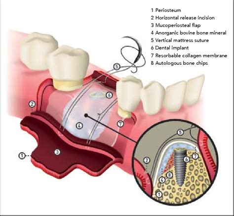 Figure 3 From Vertical Bone Grafting And Periosteal Vertical Mattress