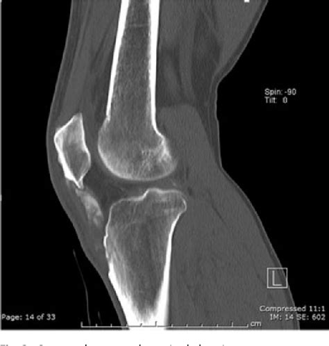 Figure 1 From Diagnosis And Treatment Of Patellar Tendon Gouty Tophus