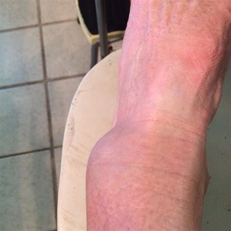 Walking on a broken foot too soon can cause further injury. How to Tell If Your Ankle Is Broken