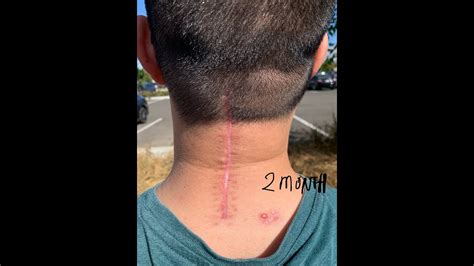 MY SCAR AFTER MONTHS OF POSTERIOR CERVICAL DECOMPRESSION AND FUSION