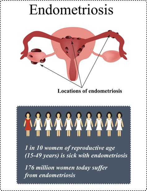 Endometriosis And Diet What You Can Do About It In 2019 Diet Vs Disease
