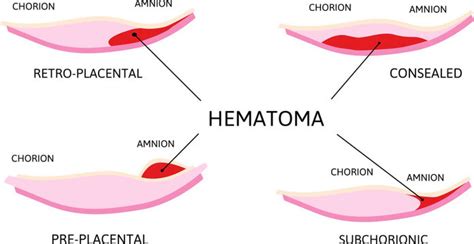 Signs Subchorionic Hematoma Resolving 5 Critical Causes Of