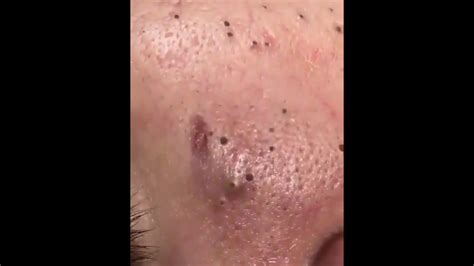 Giant Acne Removal Blackhead How To Remove Blackheadspart2 Youtube