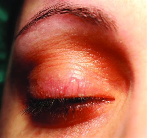 Initial Clinical Examination Revealed A Discrete Right Eyelid Swelling