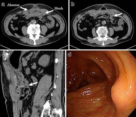 A B C Abdominal Ct Scan Showed A Localized Abscess Formation Above