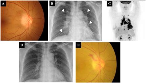 Right Optic Neuropathy And Thoracic Lymphadenopathies In Patients With
