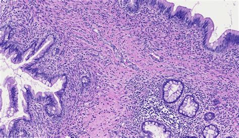 Teratoma Histology