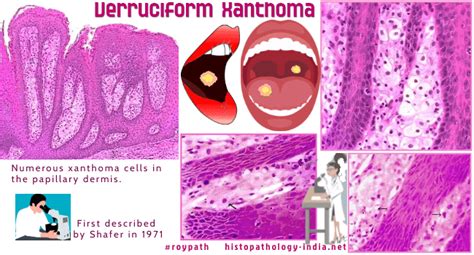Pathology Of Verruciform Xanthoma Dr Sampurna Roy Md Histopathology