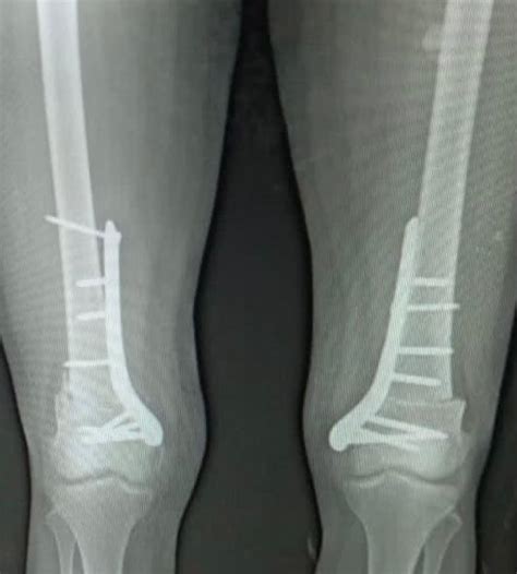 Adult Bilateral Genu Valgum Knock Knee Treatment By Dr Zahir Abbas