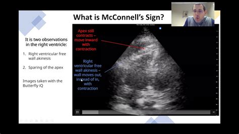 Mcconnell Sign Mcconnell Pulmonary Embolism Bmj Casereports Image Fluent